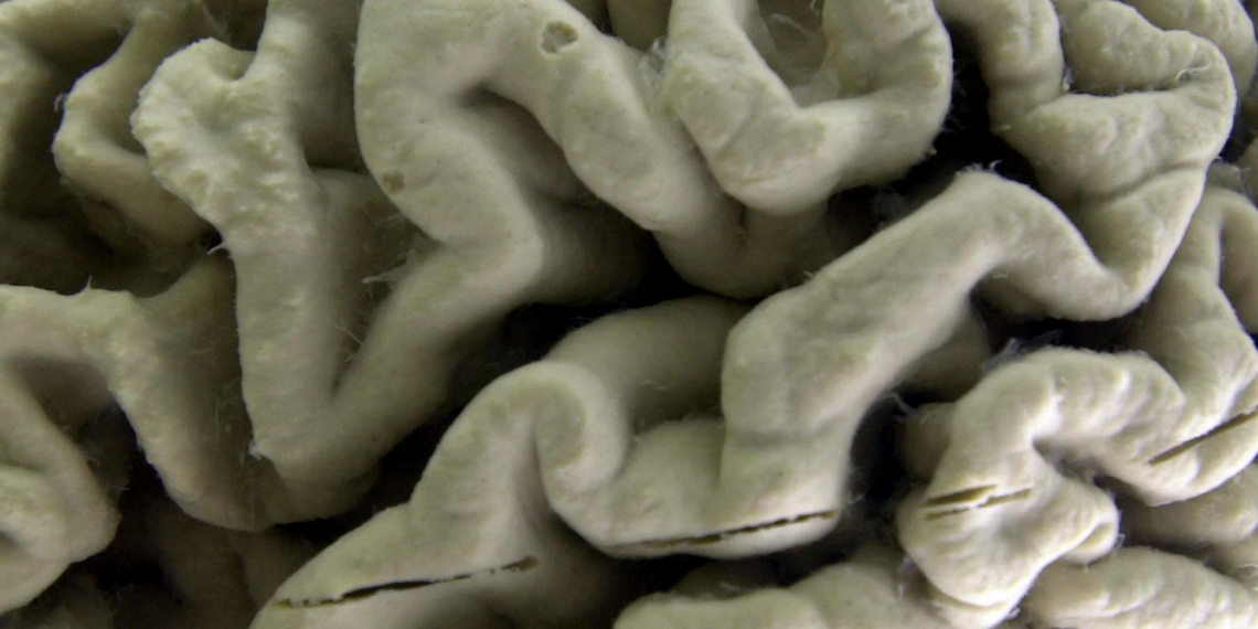 A subset of Alzheimer’s cases may be caused by two copies of a single gene, new research shows