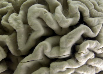 A subset of Alzheimer’s cases may be caused by two copies of a single gene, new research shows